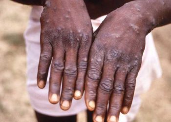 جدري القردة يتفشى في العالم.. دول تعلن إصابات مؤكدة