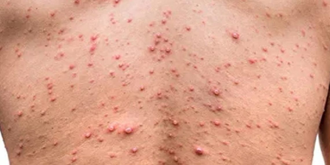 يشتبه في إصابتها بجدري القردة: اليوم تصدر نتائج التحليل لإمرأة بصفاقس