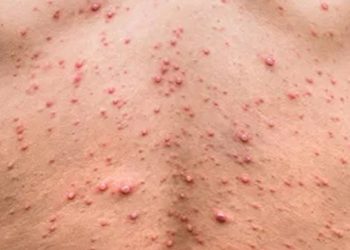 يشتبه في إصابتها بجدري القردة: اليوم تصدر نتائج التحليل لإمرأة بصفاقس