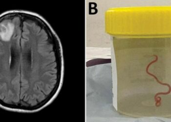 أستراليا: اكتشاف دودة حية في دماغ امرأة لأول مرة في العالم
