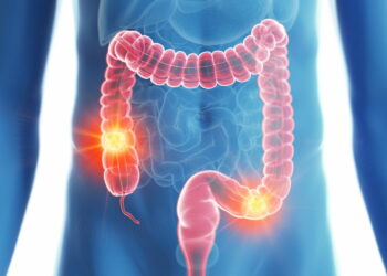 خلال 2023: تونس تسجل 3788 إصابة بسرطان القولون