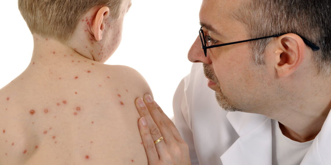 صحّة: التّلقيح خفض إصابات الحصبة عالميّا بنسبة 71 بالمائة