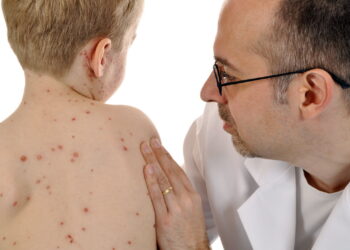 صحّة: التّلقيح خفض إصابات الحصبة عالميّا بنسبة 71 بالمائة