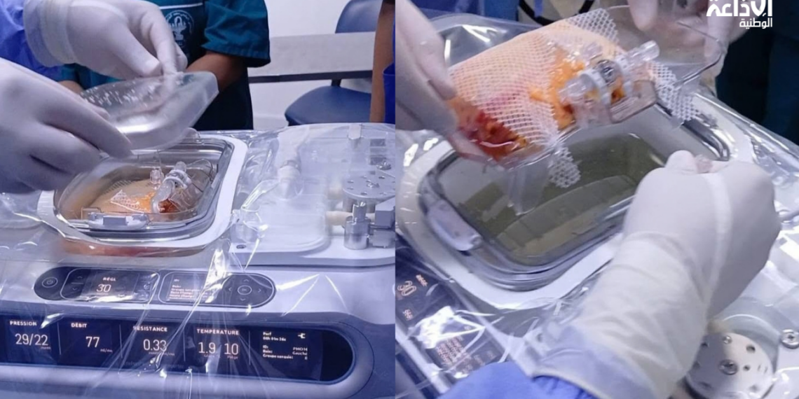 إنجاز طبّي : نجاح في استخدام تقنيّة “لايف بورت” لحفظ الكلى المجهّزة للزرع