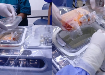 إنجاز طبّي : نجاح في استخدام تقنيّة “لايف بورت” لحفظ الكلى المجهّزة للزرع