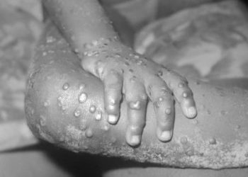 La variole du singe: plusieurs cas confirmés en Europe