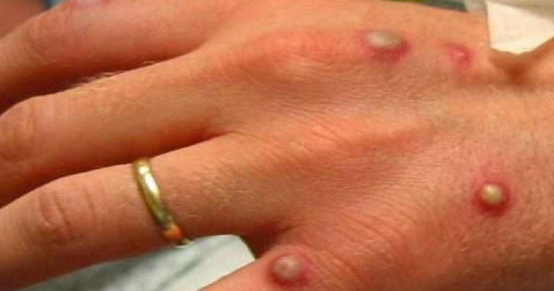 Variole du singe: ce que vous devez savoir