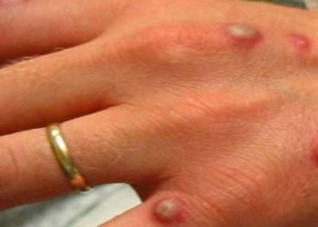 Variole du singe: ce que vous devez savoir