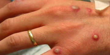 Variole du singe: ce que vous devez savoir