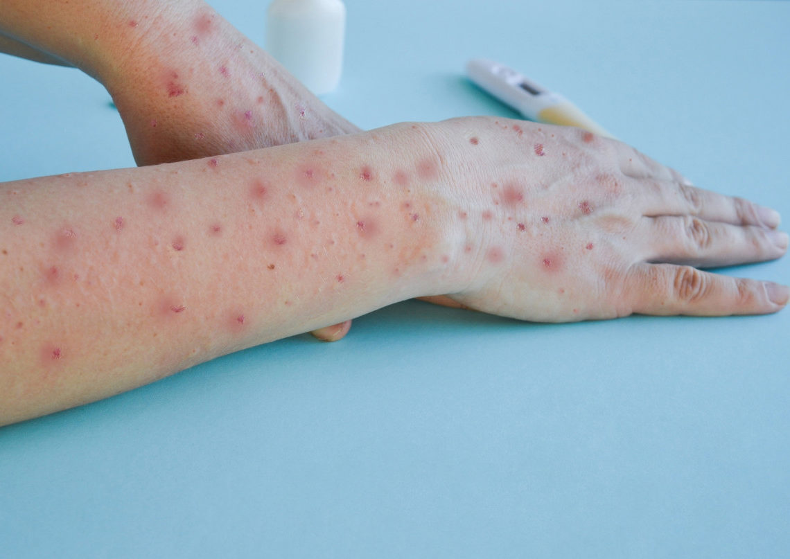 Variole du singe: un second décès en Espagne