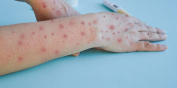 Variole du singe: un second décès en Espagne