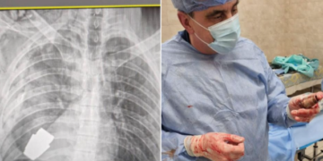 Guerre en Ukraine : une grenade non-explosée retirée de la poitrine d’un soldat grâce à des chirurgiens