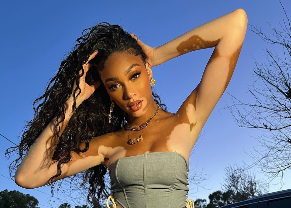 25 juin, journée internationale du Vitiligo: ce que vous devez savoir sur cette maladie qui pourrait disparaitre par une simple crème