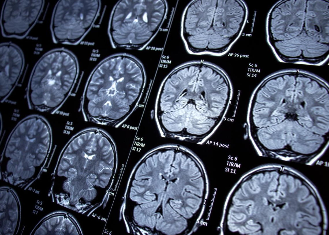 La pauvreté rend-elle moins intelligent?