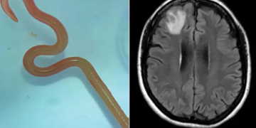 « Vivant et se tortillant », un ver de 8 cm extrait du cerveau d&rsquo;une australienne