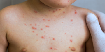 L’OMS alerte face à la forte hausse du nombre de cas de rougeole dans le monde