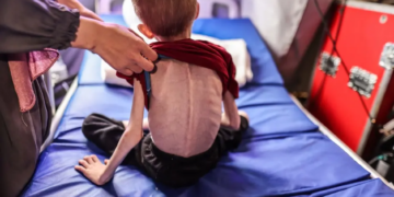Plus de 8 000 enfants de moins de 5 ans traités pour malnutrition aiguë à Gaza, alerte l’OMS
