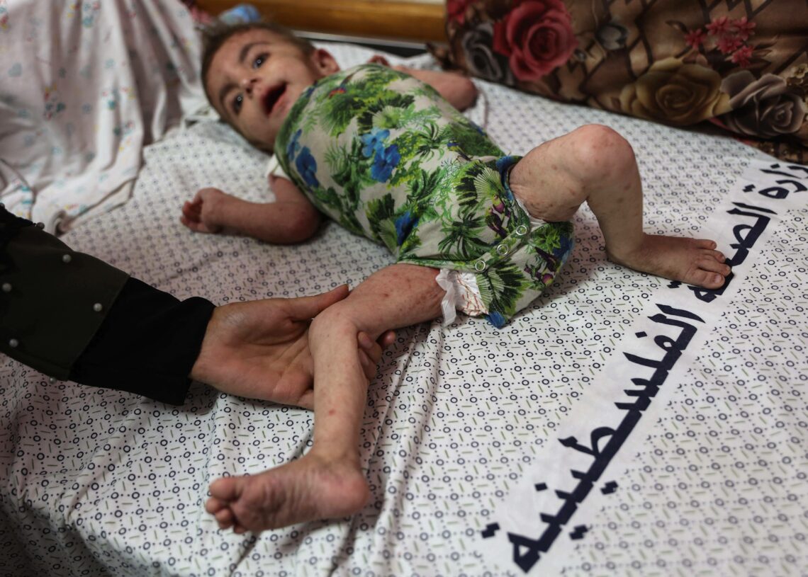 A Gaza, la gale et les poux se répandent parmi les enfants