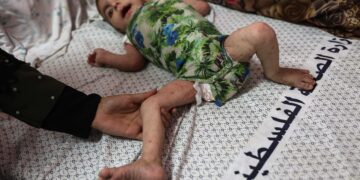 A Gaza, la gale et les poux se répandent parmi les enfants