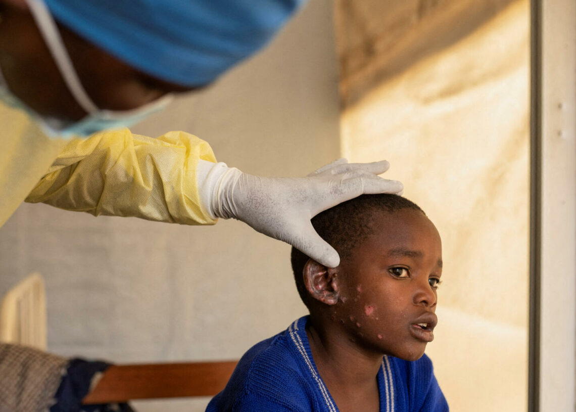 Nouvelle souche du virus Mpox: Pourquoi l’OMS est si inquiète?