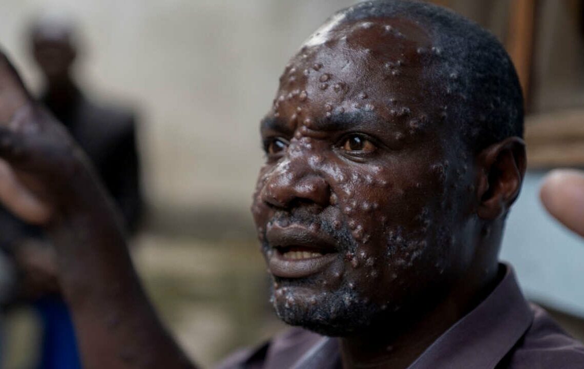 Variole du singe en Afrique: l’agence de santé de l’Union africaine déclare «une urgence de santé publique»