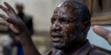 Variole du singe en Afrique: l’agence de santé de l’Union africaine déclare «une urgence de santé publique»