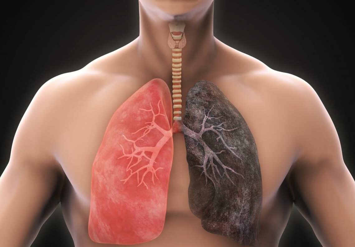 D’ici fin 2024: L’ intervention chirurgicale du cancer du poumon sera couverte par la CNAM