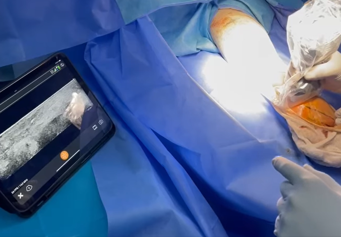 Plus besoin de bistouri: L’hôpital Charles Nicolle se distingue par une intervention chirurgicale par ultrasons