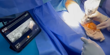 Plus besoin de bistouri: L&rsquo;hôpital Charles Nicolle se distingue par une intervention chirurgicale par ultrasons