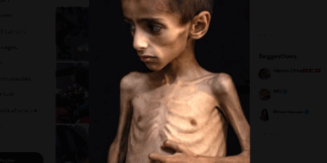 Gaza: 21 enfants sont morts de malnutrition en 72h
