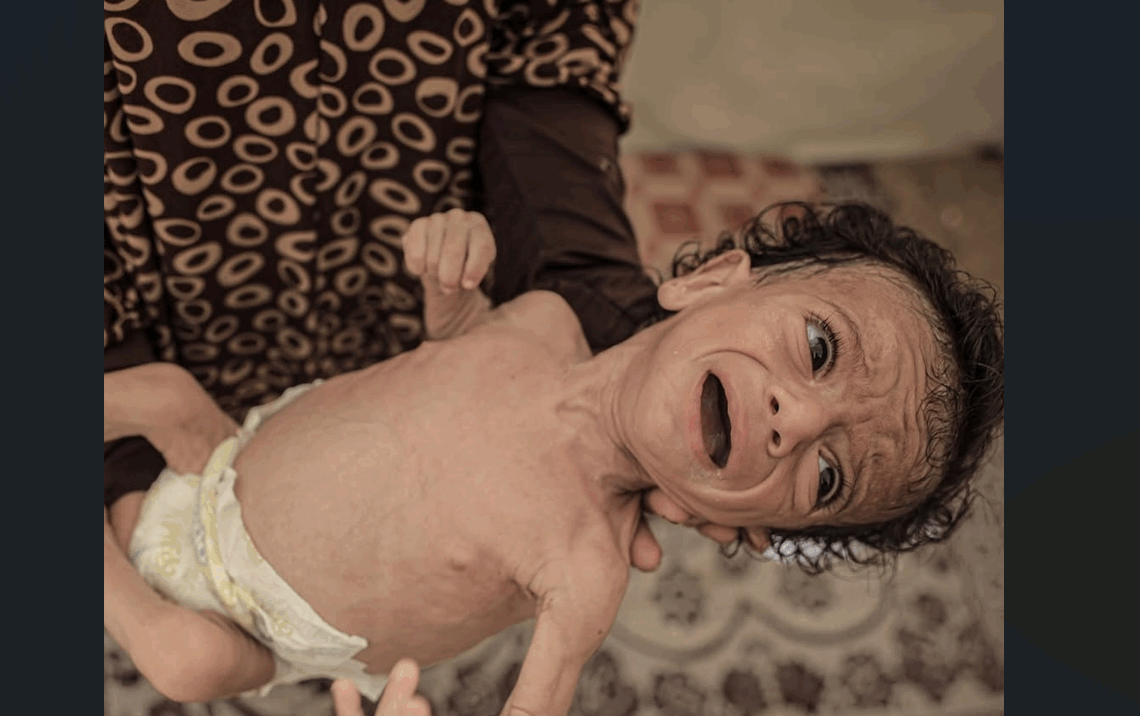 Les taux de malnutrition dans la bande de Gaza atteignent des « niveaux alarmants », selon l’OMS