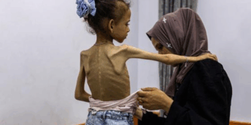 Hausse de 700%: Médecins du monde et Action contre la faim alertent sur l&rsquo;explosion de la malnutrition à Gaza