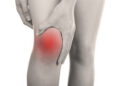 L’usure du cartilage du genou touche près de 40 % des plus de 45 ans